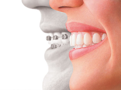 A split image of a smiling woman s face, one half showing her natural teeth and the other half revealing a dental implant.