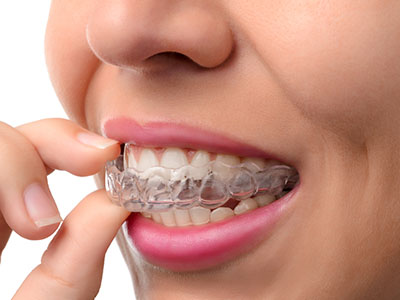 A person with a clear orthodontic aligner, brushing their teeth.