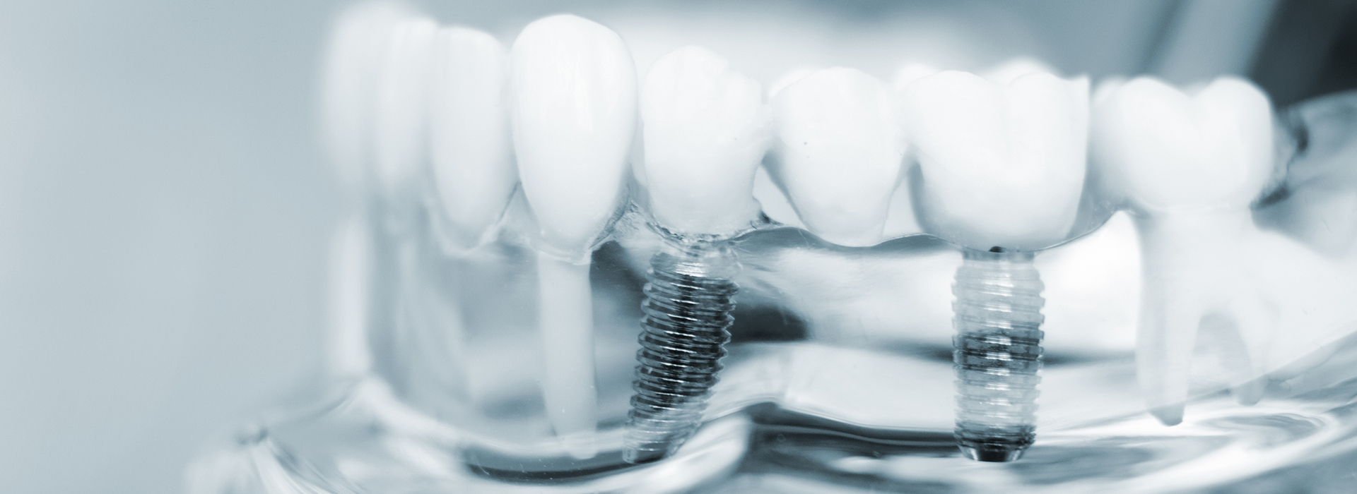 An image of a close-up of a dental implant with screws and abutments, showcasing the implant s components.