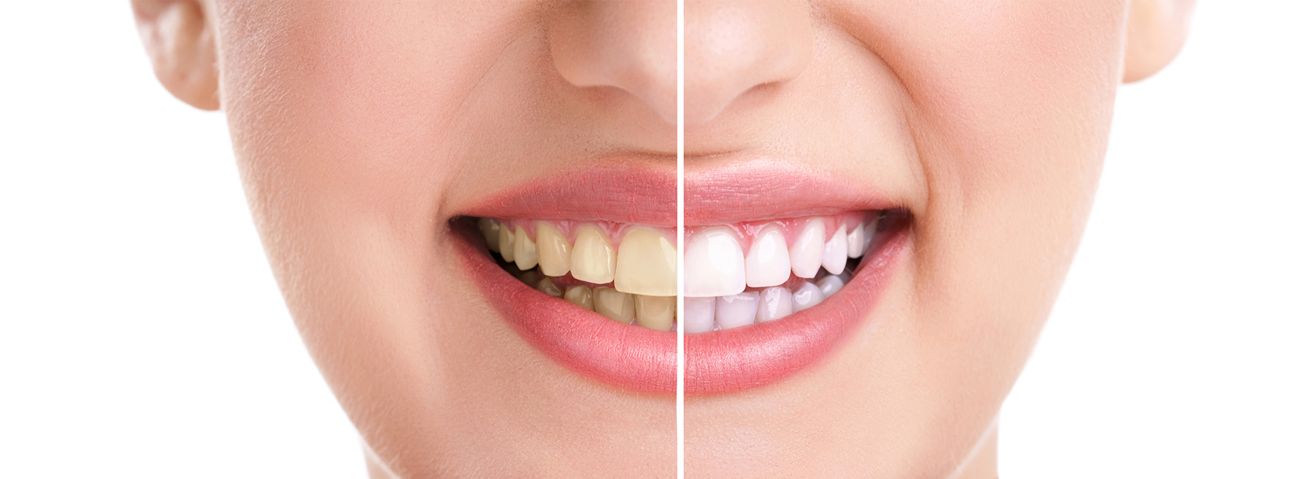 Before-and-after image of a smiling woman highlighting teeth whitening.