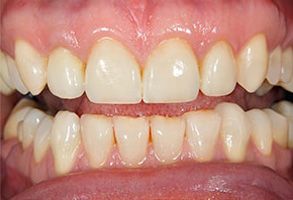 The image shows a close-up of a person s teeth with visible staining and discoloration, which suggests poor oral hygiene.