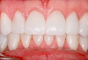 The image shows a close-up view of a person s teeth, which appear to be in the process of being whitened or straightened.