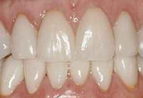 The image shows a close-up view of a person s teeth, with the focus on the upper front teeth, which appear to be white and possibly have some minor staining or discoloration.