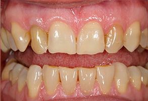 An image of a close-up view of a person s teeth with an overbite, showcasing yellowing and staining, set against a plain background.